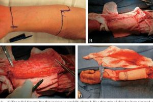 Complete Finished Metoidioplasty: Results & Options Best Final Touch: Elevate Your Projects with Professional Finishing Complete Finished Metoidioplasty: Results & Options | Best Final Touch: Elevate Your Projects with Professional Finishing