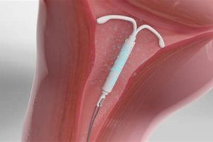 IUD & Sex: Can He Finish In You With Mirena? Safety Guide Best Final Touch: Elevate Your Projects with Professional Finishing IUD & Sex: Can He Finish In You With Mirena? Safety Guide | Best Final Touch: Elevate Your Projects with Professional Finishing