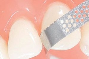 Achieve Perfect Polish: Finishing Strips Dental Guide | Best Final Touch: Elevate Your Projects with Professional Finishing